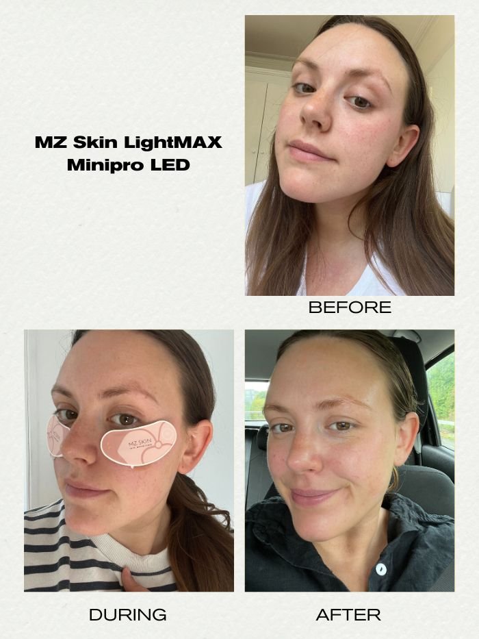 poppy nash before and after using an LED eye mask