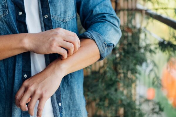 How To Know if Your Mosquito Bite Is Skeeter Syndrome